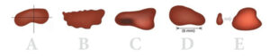 Melanoma