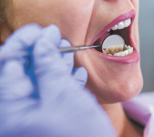 Oral Cancer