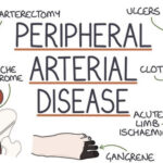 Peripheral Artery Disease