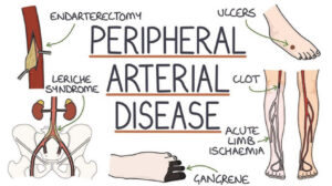 Peripheral Artery Disease