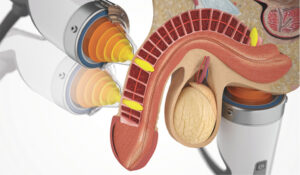 Erectile Dysfunction