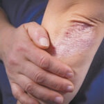 Psoriasis