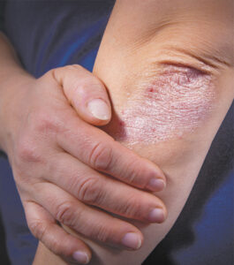 Psoriasis