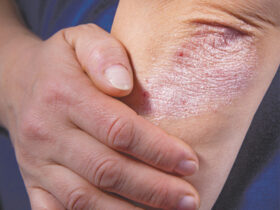 Psoriasis