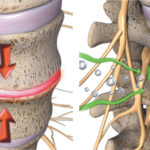 Spinal Decompression