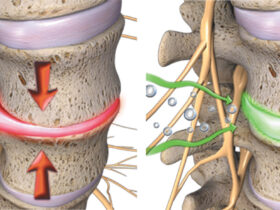 Spinal Decompression