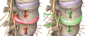 Spinal Decompression