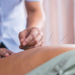 Acupuncture