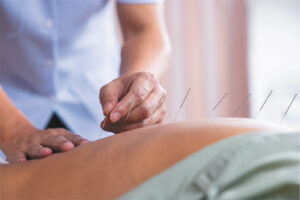 Acupuncture 