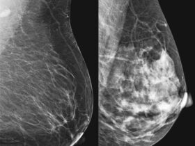 Mammograms