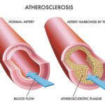 Peripheral Artery Disease