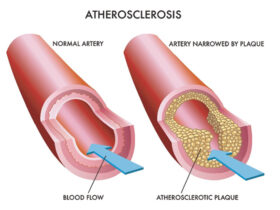 Peripheral Artery Disease