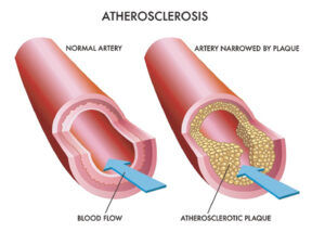 Peripheral Artery Disease
