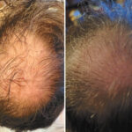 Hair Transplants