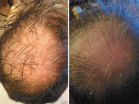 Hair Transplants