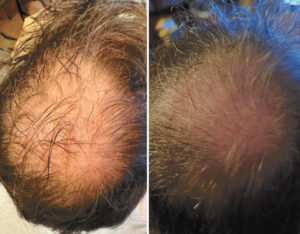 Hair Transplants