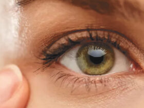 Meibomian Gland Dysfunction