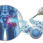 Stem Cell Therapy