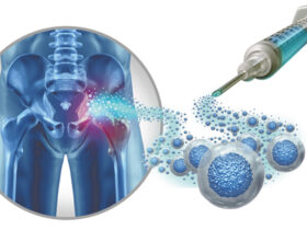 Stem Cell Therapy