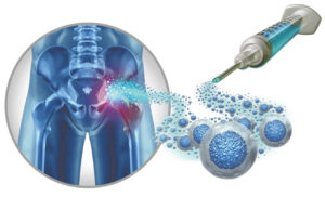 Stem Cell Therapy