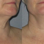 Ultherapy PRIME