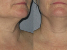 Ultherapy PRIME