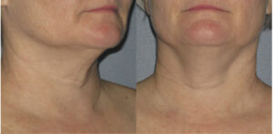 Ultherapy PRIME