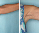 Brachioplasty