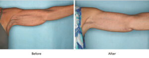 Brachioplasty