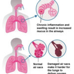 COPD in Seniors