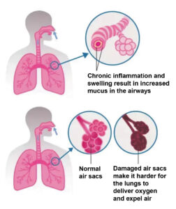 COPD in Seniors