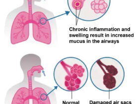 COPD in Seniors