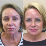 European Liquid Facelift