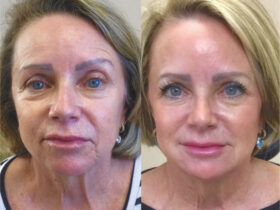 European Liquid Facelift