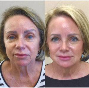 European Liquid Facelift