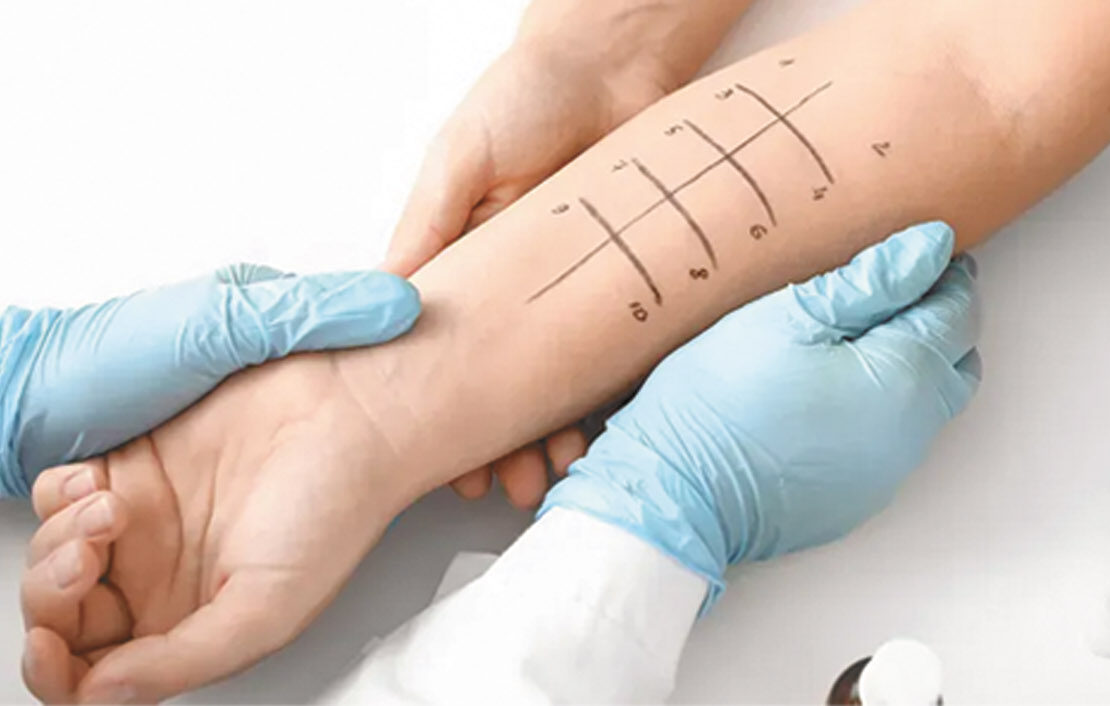 Allergy Testing and Treatment