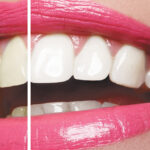 PROFESSIONAL TEETH WHITENING