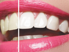 PROFESSIONAL TEETH WHITENING