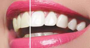 PROFESSIONAL TEETH WHITENING