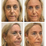 Power of Injectables