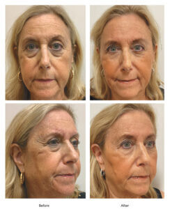 Power of Injectables