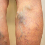 Varicose Veins