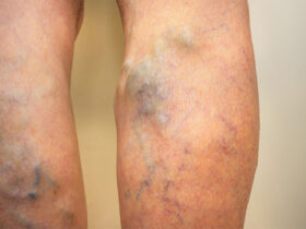Varicose Veins