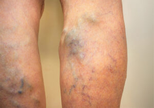 Varicose Veins