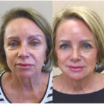 European Liquid Facelift