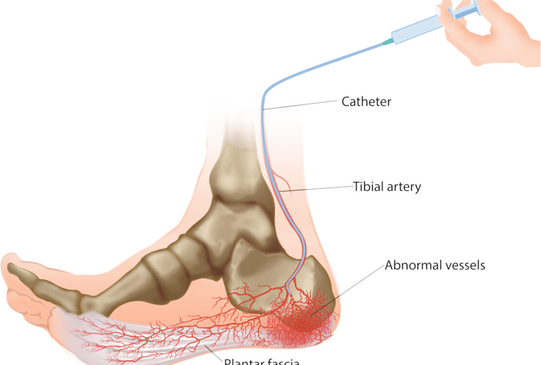Heel Pain