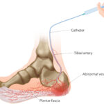Heel Pain