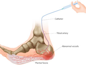 Heel Pain