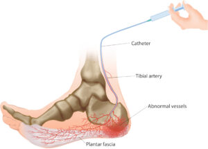 Heel Pain