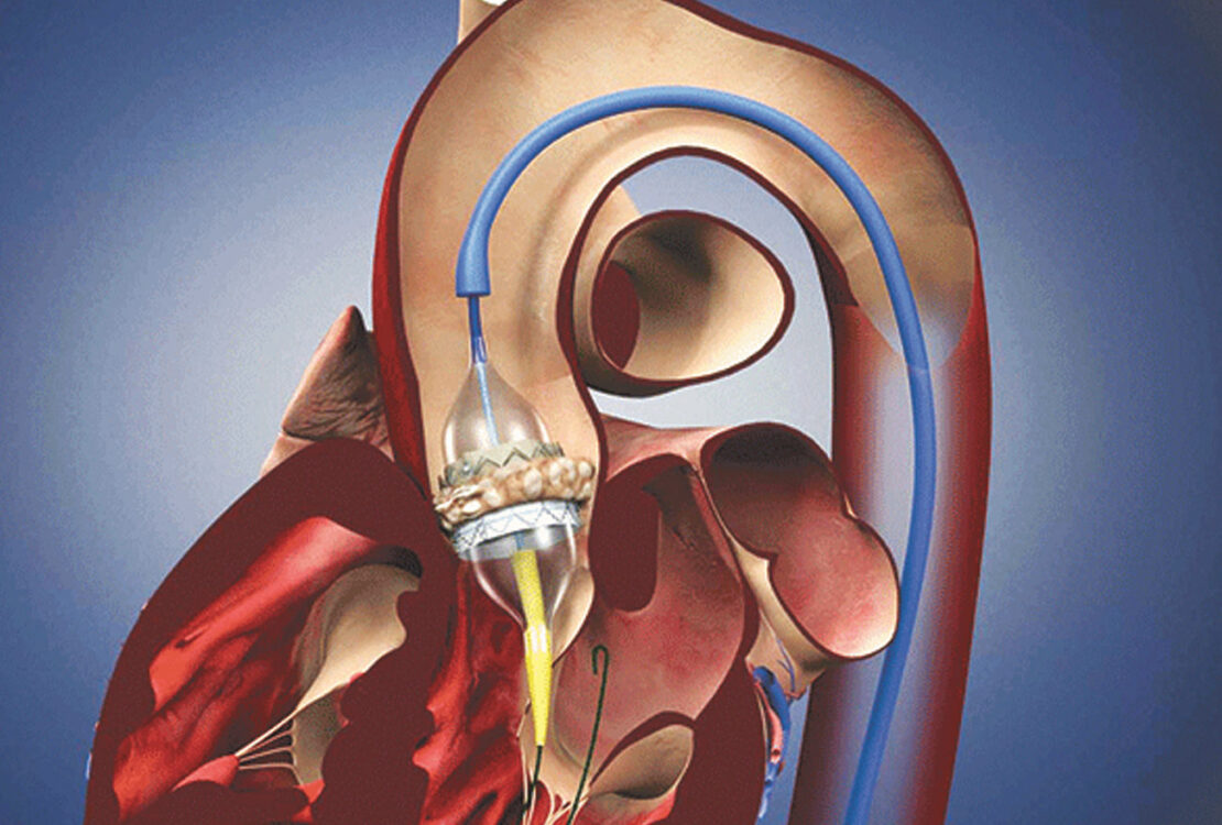 Hardened Aortic Valves